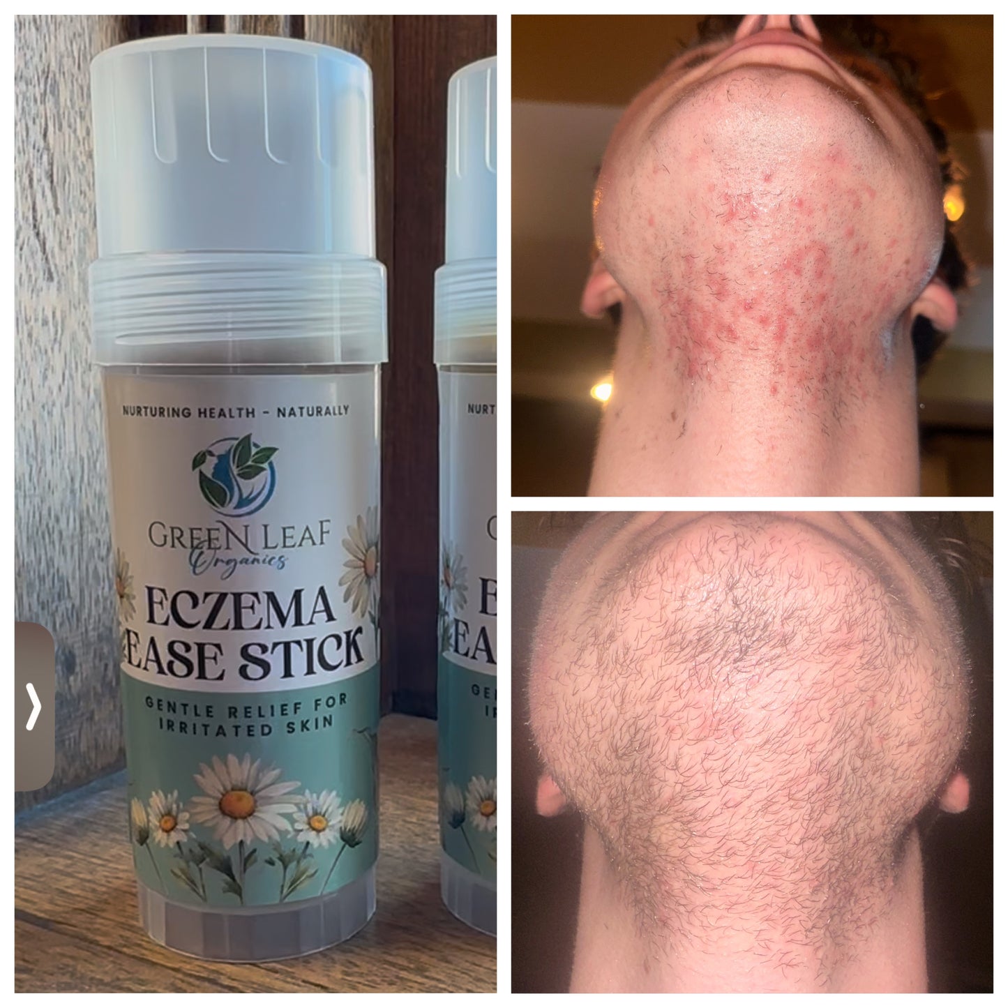 Eczema Ease Stick - Soothing Relief for Sensitive Skin