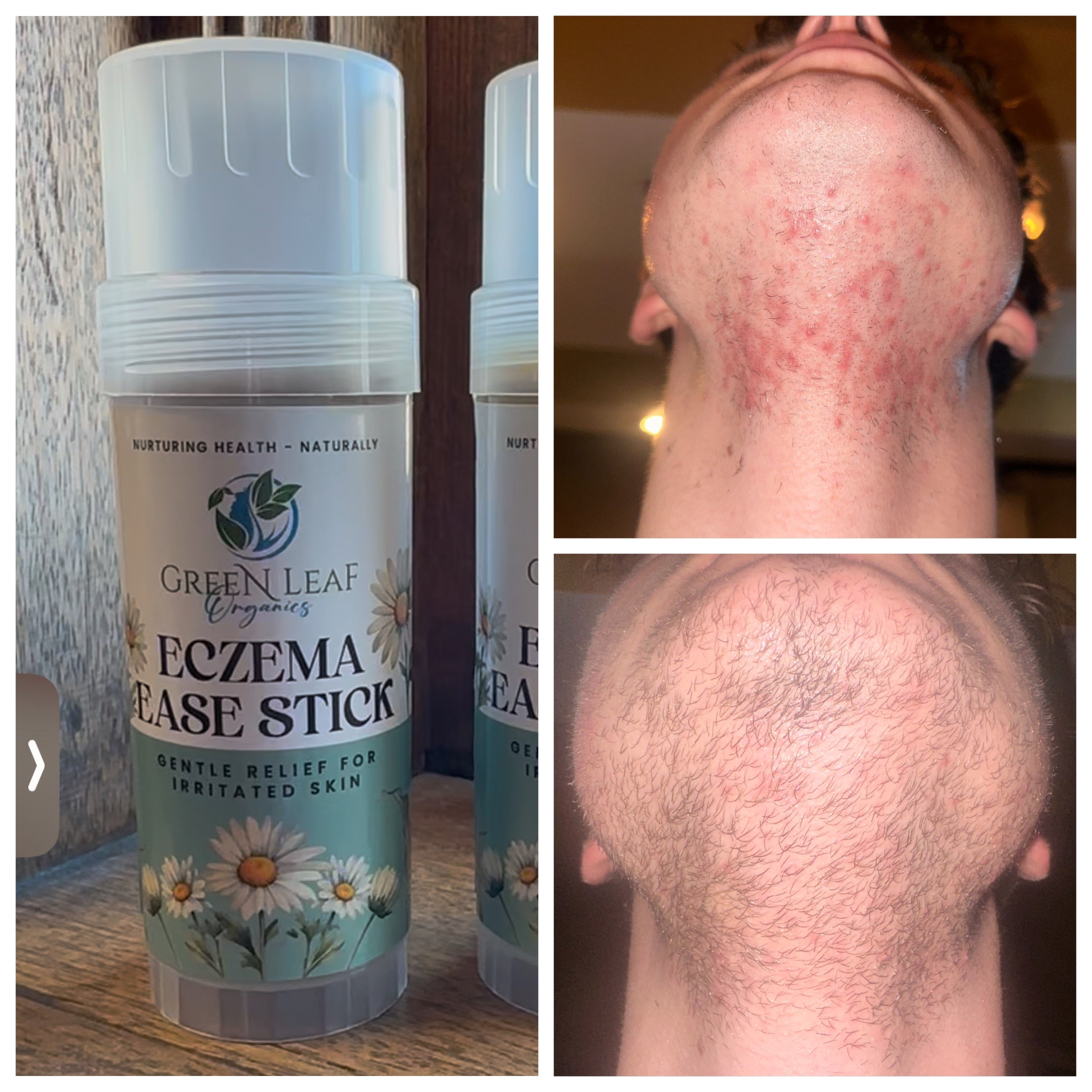 Eczema Ease Stick - Soothing Relief for Sensitive Skin